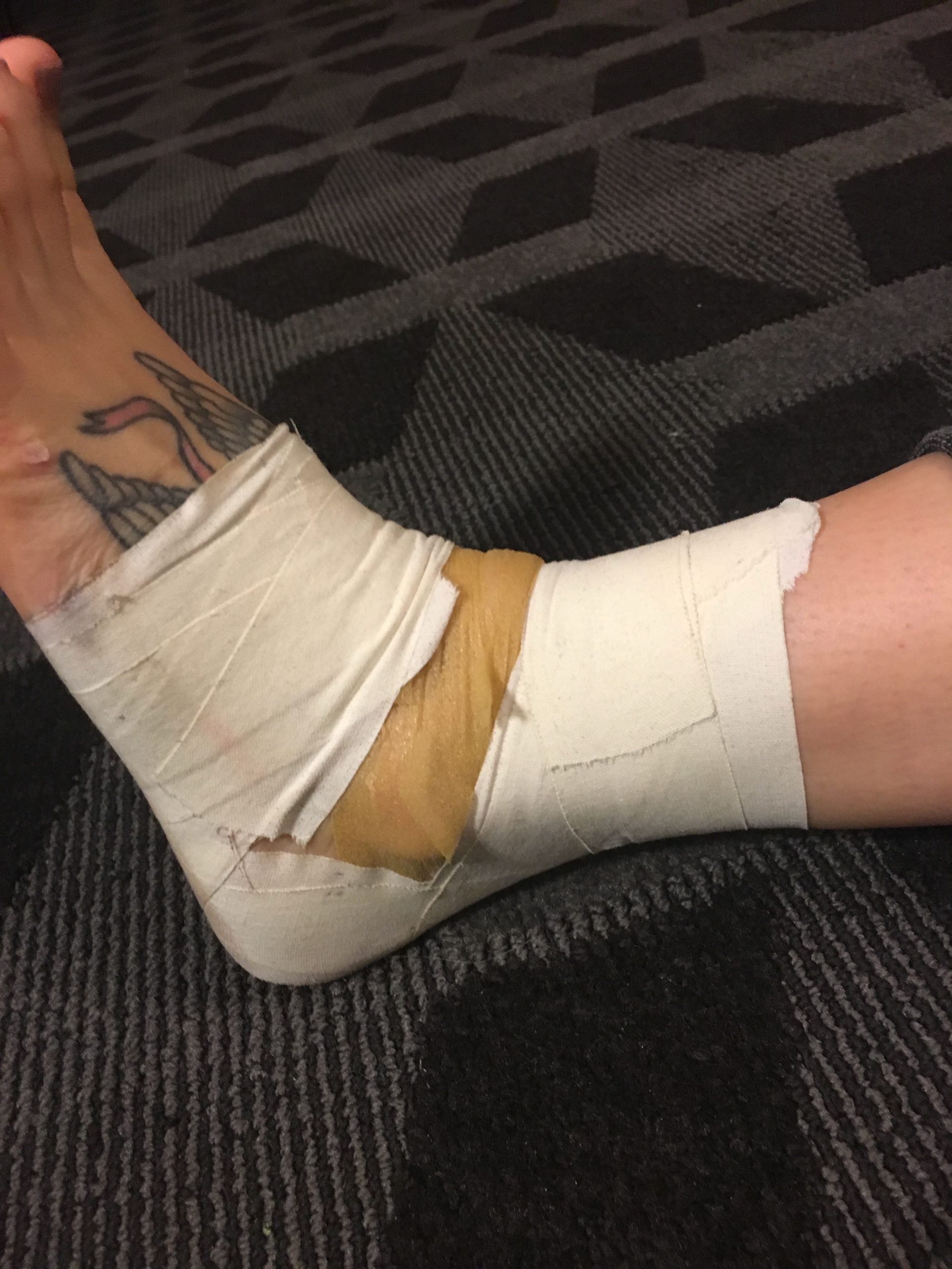 Closeup of dance related ankle sprain wrapped in athletic tape